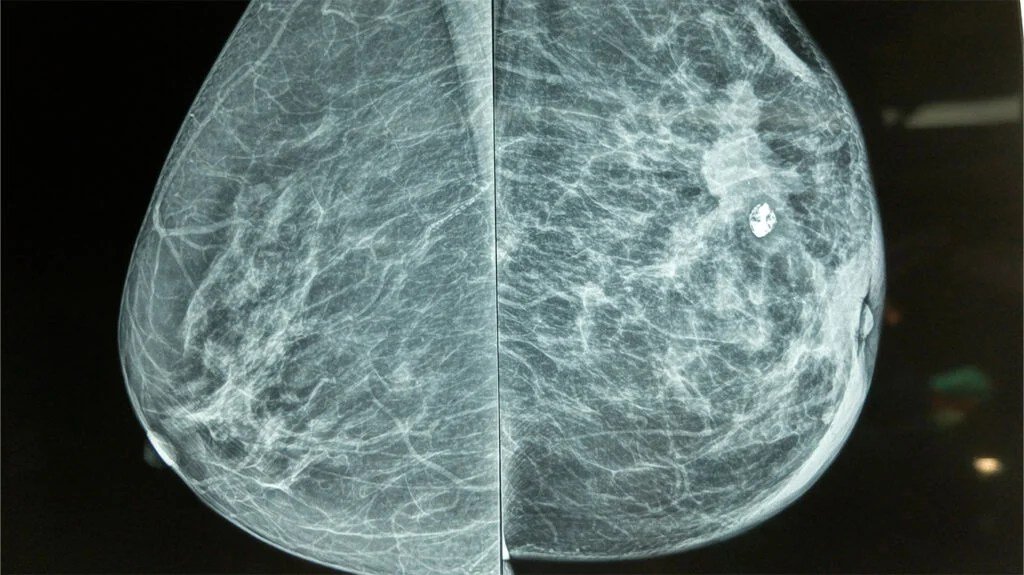 Early detection, treatment and mental health care vital to cut breast cancer deaths, say experts